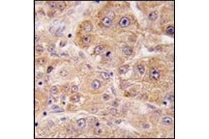 Formalin-fixed and paraffin-embedded human hepatocarcinoma tissue reacted with UVRAG Antibody , which was peroxidase-conjugated to the secondary antibody, followed by DAB staining.