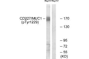 Immunohistochemistry analysis of paraffin-embedded human breast carcinoma tissue using CD227/MUC1 (Phospho-Tyr1229) antibody. (MUC1 antibody  (pTyr1229))