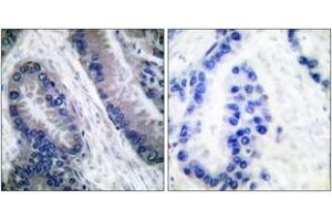 Immunohistochemistry analysis of paraffin-embedded human lung carcinoma, using IL-1 beta (Cleaved-Asp210) Antibody. (IL-1 beta antibody  (Cleaved-Asp210))
