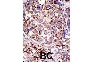 Formalin-fixed and paraffin-embedded human cancer tissue reacted with USP3 polyclonal antibody  , which was peroxidase-conjugated to the secondary antibody, followed by DAB staining. (USP3 antibody  (C-Term))