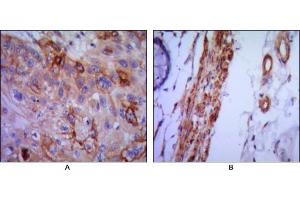 Immunohistochemical analysis of paraffin-embedded human lung cancer (A) and colon cancer (B) using VCAM1 mouse mAb with DAB staining. (VCAM1 antibody)
