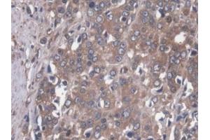 Detection of MAP4 in Human Prostate cancer Tissue using Polyclonal Antibody to Microtubule Associated Protein 4 (MAP4) (MAP4 antibody  (AA 243-549))