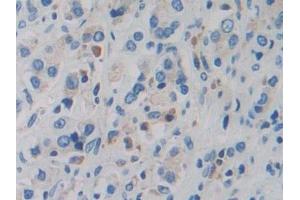 Detection of DDX58 in Human Prostate cancer Tissue using Polyclonal Antibody to Probable ATP-dependent RNA Helicase DDX58 (DDX58) (DDX58 antibody  (AA 550-776))