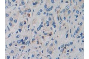 Detection of DDX58 in Human Prostate cancer Tissue using Polyclonal Antibody to Probable ATP-dependent RNA Helicase DDX58 (DDX58)