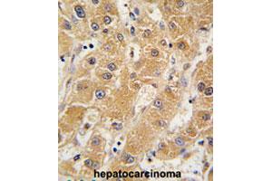 Formalin-fixed and paraffin-embedded human hepatocarcinomareacted with APOA5 polyclonal antibody , which was peroxidase-conjugated to the secondary antibody, followed by AEC staining.