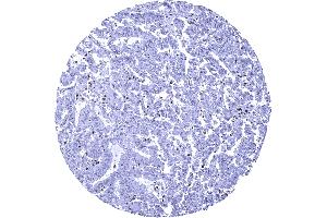 Colon Colorectal adenocarcinoma with strong MSH6 immunostaining in stromal and inflammatory cells but absent MSH6 staining in cancer cells (Recombinant MSH6 antibody  (AA 1-100))