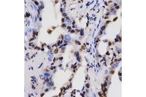 Immunohistochemistry of paraffin-embedded human lung cancer using Dimethyl-Histone H3-K4 antibody (ABIN5969803) at dilution of 1/200 (40x lens). (Histone 3 antibody  (H3K4me2))