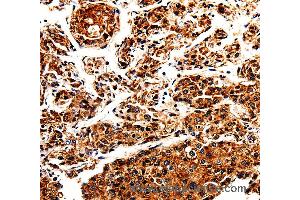 Immunohistochemistry of Human liver cancer using APLP1 Polyclonal Antibody at dilution of 1:25 (APLP1 antibody)