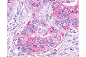 Anti-NPFF2 / NPFFR2 antibody IHC of human Pancreas, Carcinoma. (NPFFR2 antibody  (Extracellular Domain))