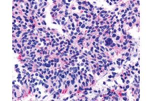 Anti-CHRM5 / M5 antibody IHC of human Lung, Small Cell Carcinoma. (CHRM5 antibody  (Cytoplasmic Domain))