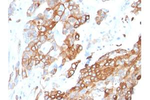 Formalin-fixed, paraffin-embedded human Breast Carcinoma stained with Heregulin-1 Mouse Monoclonal Antibody (NRG1/2710). (Neuregulin 1 antibody  (AA 21-242))