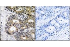 Immunohistochemistry analysis of paraffin-embedded human colon carcinoma, using TRAPPC6A Antibody.