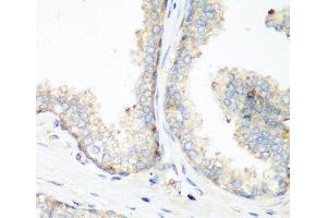 Immunohistochemistry of paraffin-embedded Human prostate using NEDD4 Polyclonal Antibody at dilution of 1:200 (40x lens). (NEDD4 antibody)