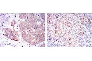 Immunohistochemical analysis of paraffin-embedded liver cancer (left) and submaxillary tumor (right) using EIF4E mouse mAb with DAB staining.