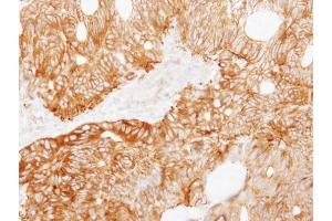IHC-P Image Immunohistochemical analysis of paraffin-embedded human colon carcinoma, using Ladinin 1, antibody at 1:250 dilution.