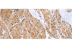 Immunohistochemistry of paraffin-embedded Human esophagus cancer tissue using SLC4A3 Polyclonal Antibody at dilution of 1:35(x200) (SLC4A3 antibody)