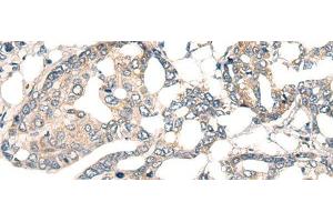 Immunohistochemistry of paraffin-embedded Human liver cancer tissue using CORO2A Polyclonal Antibody at dilution of 1:45(x200) (CORO2A antibody)