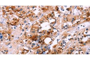 Immunohistochemistry of paraffin-embedded Human thyroid cancer using CALB1 Polyclonal Antibody at dilution of 1:60 (CALB1 antibody)