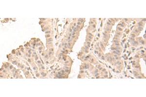 Immunohistochemistry of paraffin-embedded Human thyroid cancer tissue using SAP130 Polyclonal Antibody at dilution of 1:50(x200)
