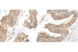 Immunohistochemistry of paraffin-embedded Human colorectal cancer tissue using SLC6A9 Polyclonal Antibody at dilution of 1:25(x200) (GLYT1 antibody)