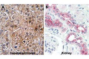 Formalin-fixed and paraffin-embedded human hepatocarcinoma (A) and human kidney (B) tissue reacted with BMPR2 polyclonal antibody , which was peroxidase-conjugated to the secondary antibody, followed by DAB staining. (BMPR2 antibody  (AA 28-59))