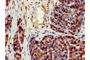 Immunohistochemistry of paraffin-embedded human ovarian cancer using ABIN7150470 at dilution of 1:100 (CRCP antibody  (AA 1-115))