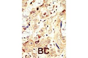 Formalin-fixed and paraffin-embedded human cancer tissue reacted with ERBB4 polyclonal antibody  , which was peroxidase-conjugated to the secondary antibody, followed by DAB staining. (ERBB4 antibody  (N-Term))