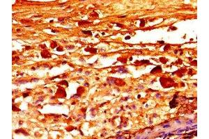 Immunohistochemistry of paraffin-embedded human melanoma using ABIN7152751 at dilution of 1:100 (Fibrillin 1 antibody  (AA 783-850))