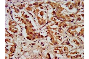 IHC image of ABIN7157898 diluted at 1:200 and staining in paraffin-embedded human liver cancer performed on a Leica BondTM system. (LAMC2 antibody  (AA 417-588))