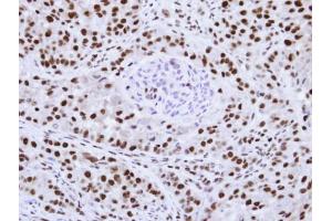 IHC-P Image Immunohistochemical analysis of paraffin-embedded A549 Xenograft , using hnRNP F , antibody at 1:100 dilution. (HNRNPF antibody)