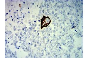 Immunohistochemical analysis of paraffin-embedded breast cancer tissues using KRT13 mouse mAb with DAB staining. (Cytokeratin 13 antibody  (AA 104-458))