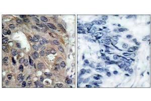 Immunohistochemical analysis of paraffin-embedded human breast carcinoma tissue using Src (phospho- Tyr529) antibody (E011153). (Src antibody  (pTyr529))