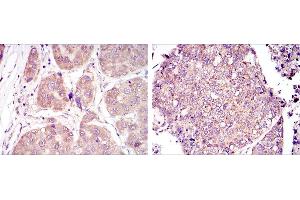 Immunohistochemical analysis of paraffin-embedded liver cancer tissues (left) and lung cancer tissues (right) using HIF1A mouse mAb with DAB staining. (HIF1A antibody)
