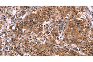 Immunohistochemistry of paraffin-embedded Human gastric cancer tissue using HACE1 Polyclonal Antibody at dilution 1:40 (HACE1 antibody)