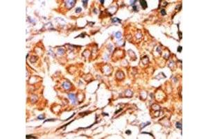 IHC analysis of FFPE human breast carcinoma stained with the Glycerol kinase antibody (GK2 antibody  (AA 487-515))