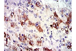Immunohistochemical analysis of paraffin-embedded liver cancer tissues using TUBA8 mouse mAb with DAB staining. (TUBA8 antibody)