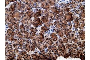 Immunohistochemical staining of paraffin-embedded Adenocarcinoma of Human colon tissue using anti-EPHX2 mouse monoclonal antibody. (EPHX2 antibody)