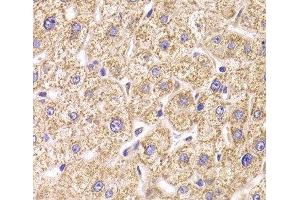 Immunohistochemistry of paraffin-embedded Human liver damage using ST3GAL3 Polyclonal Antibody at dilution of 1:100 (40x lens). (ST3GAL3 antibody)