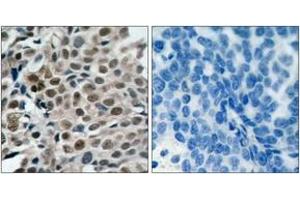 Immunohistochemistry analysis of paraffin-embedded human breast carcinoma, using FKHRL1 (Phospho-Ser253) Antibody. (FOXO3 antibody  (pSer253))