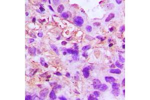 Immunohistochemical analysis of TSG6 staining in human lung cancer formalin fixed paraffin embedded tissue section. (TNFAIP6 antibody  (Center))