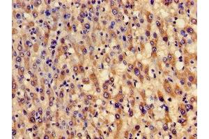 Immunohistochemistry of paraffin-embedded human liver cancer using ABIN7154002 at dilution of 1:100 (GCLM antibody  (Regulatory Subunit))
