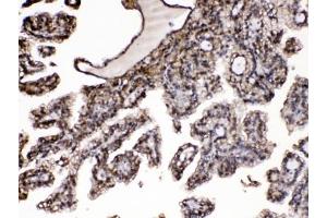 IHC testing of FFPE human renal cancer tissue with Purine nucleoside phosphorylase antibody at 1ug/ml. (PNP antibody  (AA 161-189))
