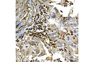 Immunohistochemistry of paraffin-embedded human liver cancer using [KO Validated]  Rabbit pAb (ABIN6133581 and ABIN6136917) at dilution of 1:100 (40x lens). (Annexin a1 antibody)