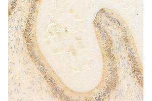 ABIN7097091 and ABIN7101158 at 1/100 staining human testicular cancer by IHC-P. (NCF1C antibody)
