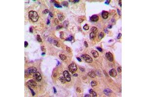 Immunohistochemical analysis of IKK beta (pS23) staining in human breast cancer formalin fixed paraffin embedded tissue section. (IKBKB antibody  (N-Term, pSer23))