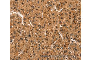 Immunohistochemistry of Human liver cancer using CCNT1 Polyclonal Antibody at dilution of 1:30 (Cyclin T1 antibody)