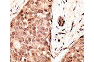 IHC analysis of FFPE human breast carcinoma tissue stained with the CDX2 antibody (CDX2 antibody  (AA 1-30))