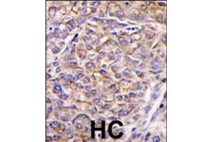 Formalin-fixed and paraffin-embedded human hepatocarcinoma tissue reacted with TAOK3 antibody , which was peroxidase-conjugated to the secondary antibody, followed by DAB staining. (TAO Kinase 3 antibody  (C-Term))