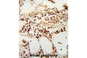 Formalin-fixed and paraffin-embedded human breast carcinoma reacted with TIMP3 Antibody (Center), which was peroxidase-conjugated to the secondary antibody, followed by DAB staining.