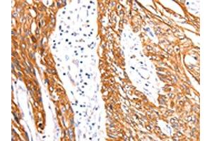 The image on the left is immunohistochemistry of paraffin-embedded Human esophagus cancer tissue using ABIN7192115(Rab3D Antibody) at dilution 1/27, on the right is treated with synthetic peptide. (RAB3D antibody)